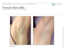 Load image into Gallery viewer, Forever Bare™ Laser Hair Removal