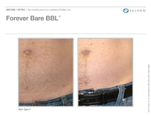 Load image into Gallery viewer, Forever Bare™ Laser Hair Removal
